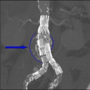 Abdominal aortic endoprosthesis, CT scan, original aneurysm marked in blue.