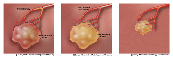 Chemoembolisation of a tumour