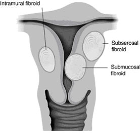 Diagram of the different types of fibroids that can form in the uterus.