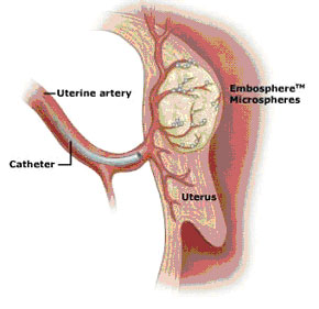 Small particles are directed into the artery supplying the fibroid.