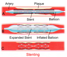 diagram of a stent being inserted where angioplasty is not successful on its own