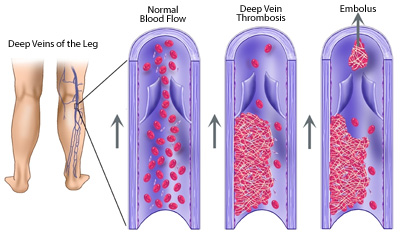 Diagram of Deep Vein Thrombosis