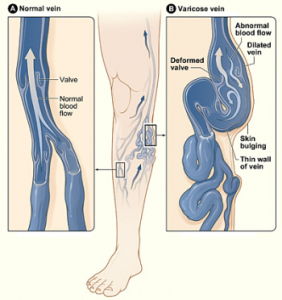 Varicose Veins can be treated by vein ablation