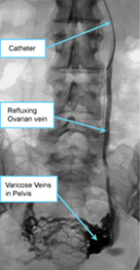 Ovarian Vein Embolisation for Pelvic Congestion Syndrome and chronic pelvic pain