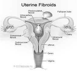 Diagram of uterine fibroids before uterine fibroid embolisation